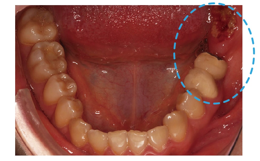 左下後牙區-假牙-臼齒殘根