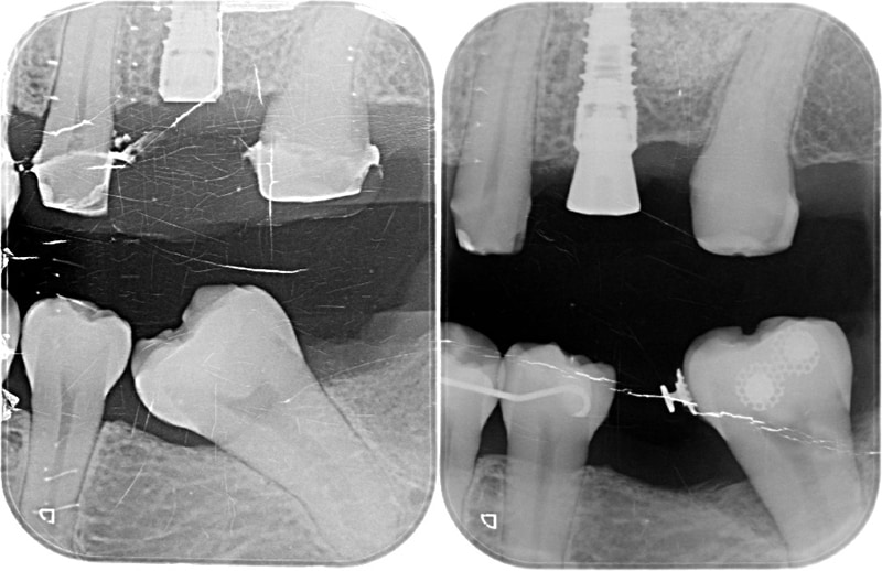 拔智齒-骨釘矯正第二大臼齒-恢復第一大臼齒空間