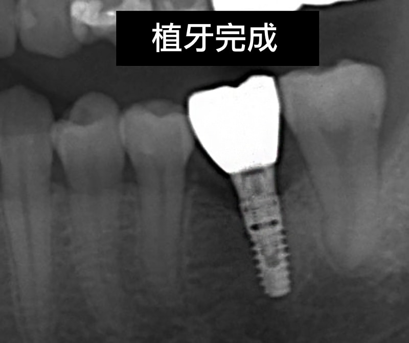 植牙完成-裝上正式假牙-X光片