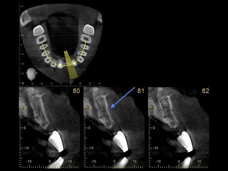植牙補骨前-電腦斷層影像-骨量不足