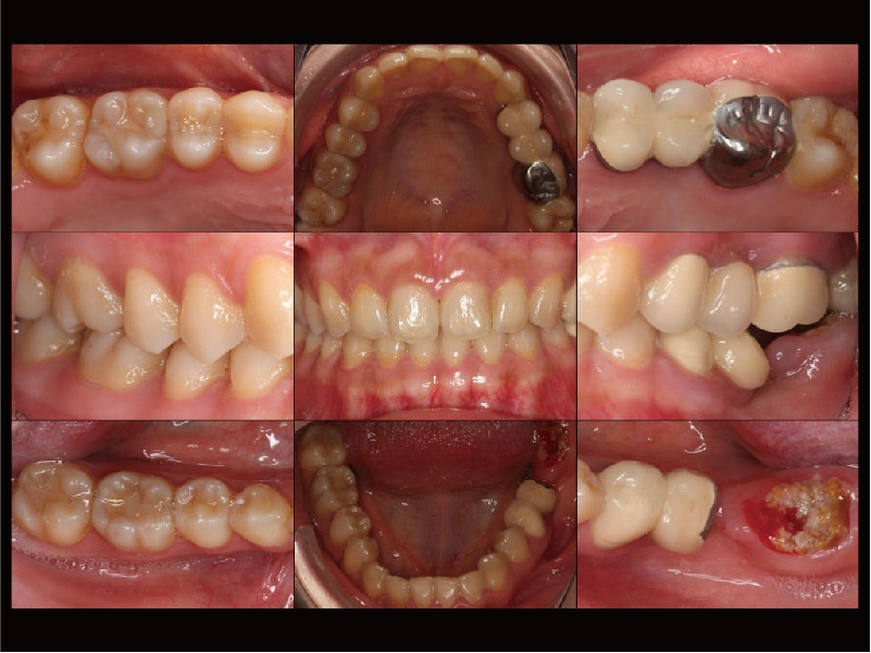 牙周病治療-治療前-完整評估檢查-各角度口腔牙齒近照