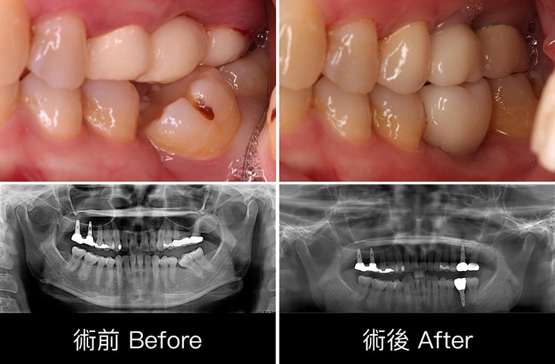 牙周病治療-牙周病手術-前後比較-牙齒近照-X光片