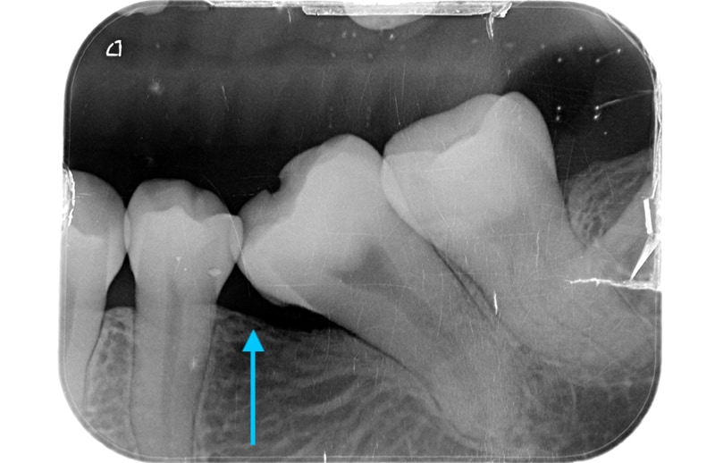 缺牙不補-清潔死角-牙周病-術前X光照