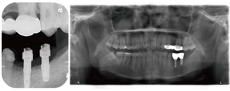 舒眠植牙-完成-X光片