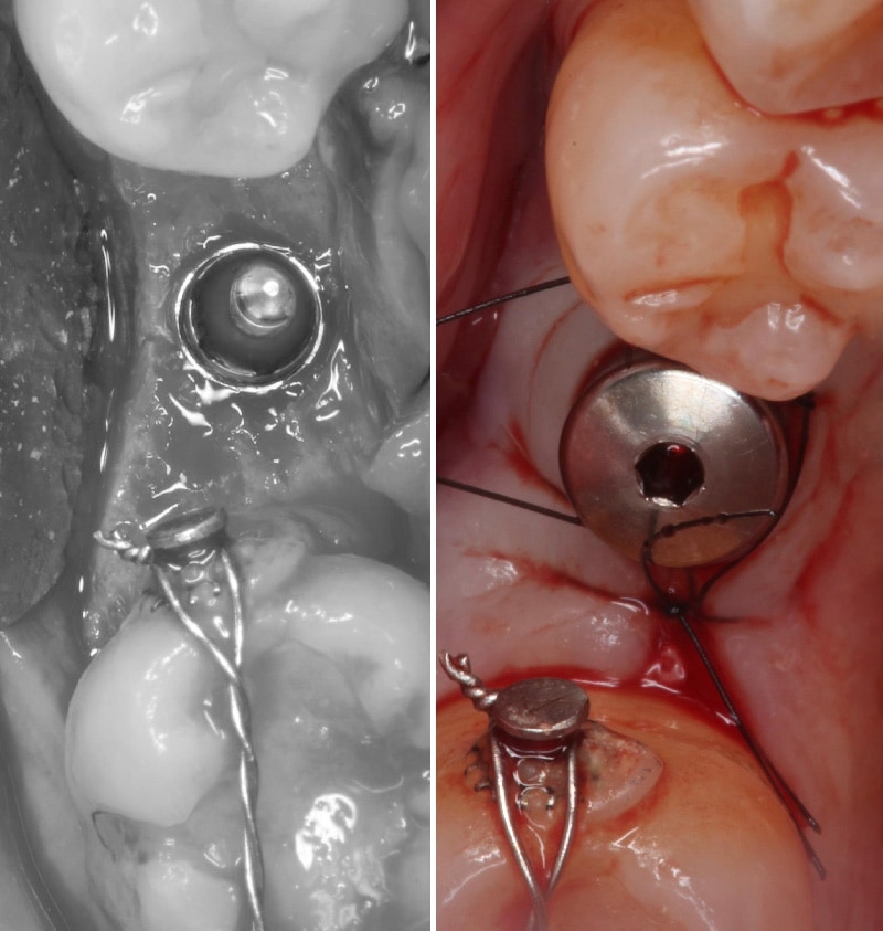 舒眠植牙-植牙手術過程-植入人工牙根