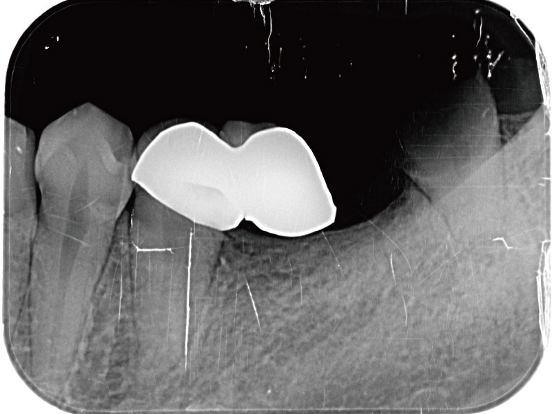 輕微牙周病-舒眠植牙-假牙拆除前-X光片