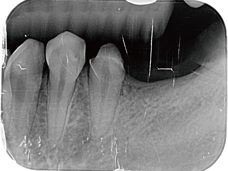 輕微牙周病-舒眠植牙-假牙拆除後-X光片