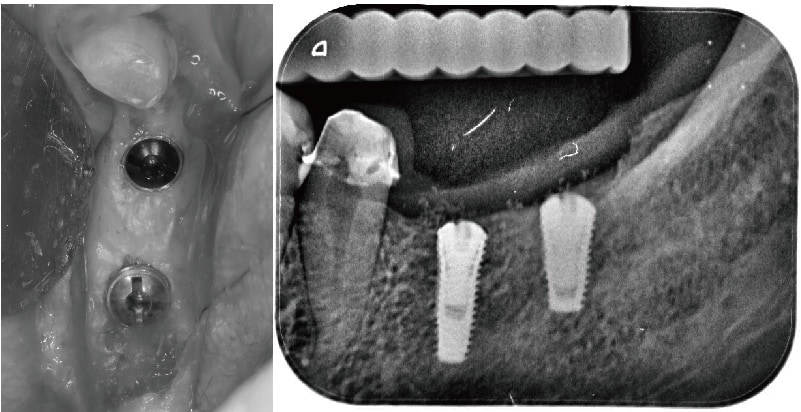 輕微牙周病-舒眠植牙-植入兩支人工牙根