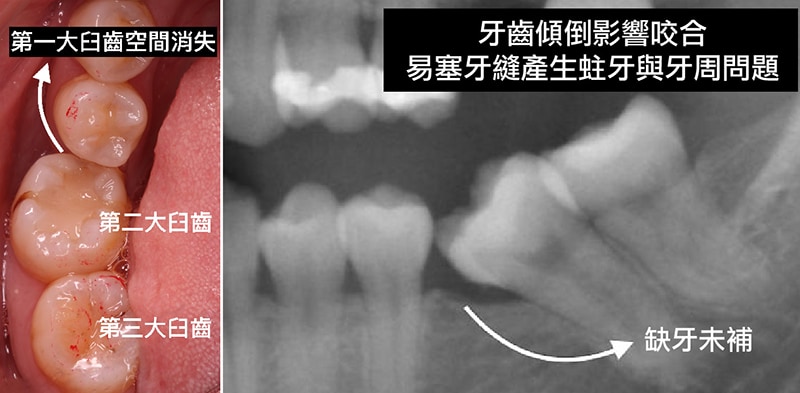 長期缺牙不補-牙齒傾倒移位-第一大臼齒空間喪失空間