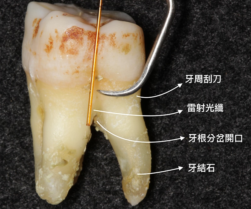 雷射光纖-牙周刮刀-牙周囊袋位置示意圖