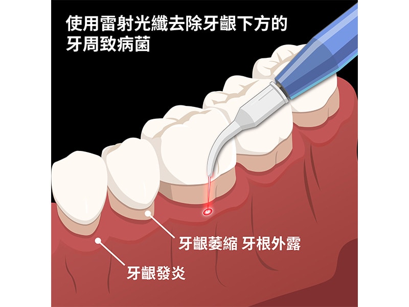 雷射牙周治療-水雷射-深入牙周囊袋殺菌-葉立維醫師-桃園牙周病