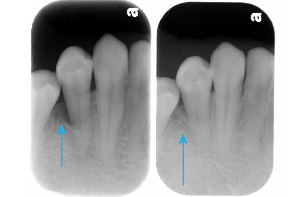 全口嚴重牙周病-雷射治療牙周病效果-治療前後-右下第二小臼齒-牙周齒槽骨自然再生