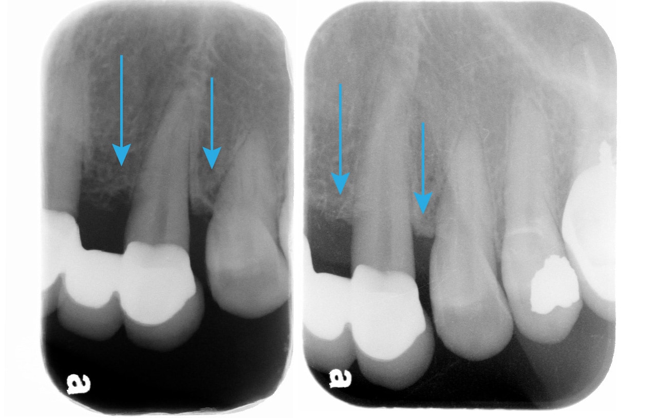 全口嚴重牙周病-雷射治療牙周病效果-治療前後-左上犬齒-牙周齒槽骨自然再生