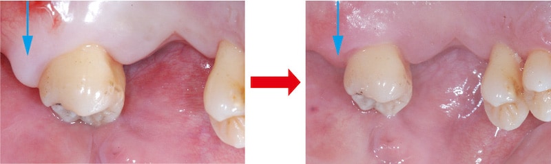嚴重牙周病-右上第二大臼齒-牙齦切除術-去除牙周囊袋-手術前後