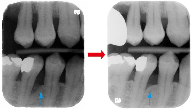 嚴重牙周病-右下第二小臼齒-非手術流程-治療前-一年後X光片-齒槽骨再生