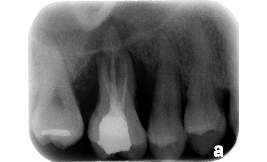 嚴重牙周病-拔牙前-X光片-齒槽骨破壞嚴重