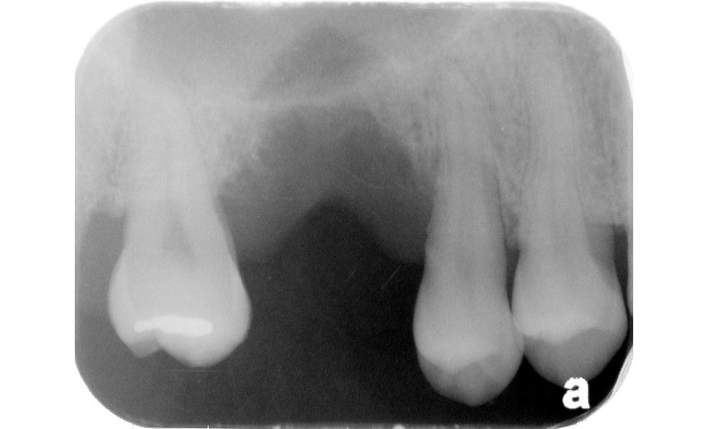 嚴重牙周病-拔牙後-X光片-齒槽骨流失