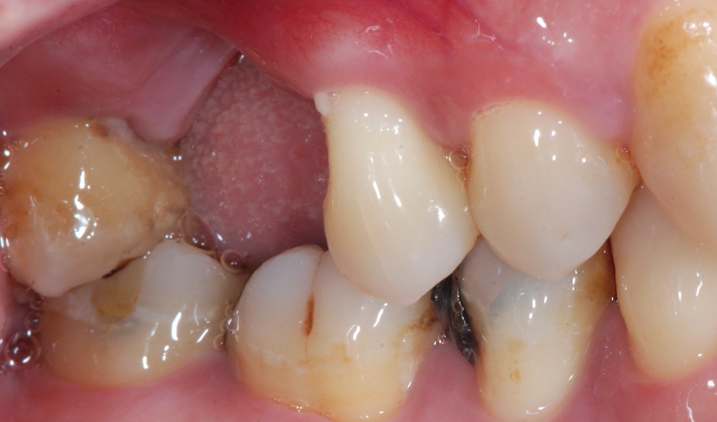 嚴重牙周病-治療前-右上第一大臼齒拔除缺牙處