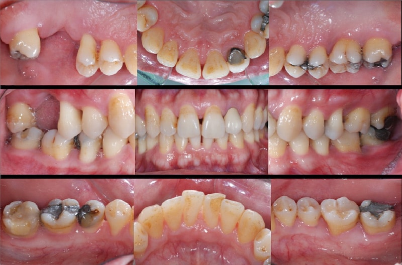 嚴重牙周病-牙周病第一階段治療後-口內拍照紀錄-牙齦紅腫已改善