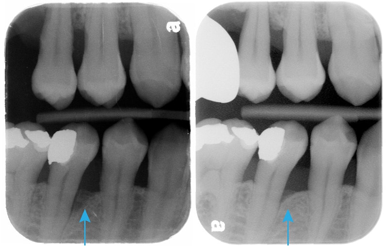 嚴重牙周病-雷射治療牙周病效果-治療前後-右下第二小臼齒-牙周齒槽骨自然再生