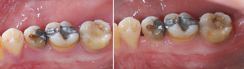 嚴重牙周病-雷射治療牙周病效果-治療前後-改善牙齦紅腫狀態