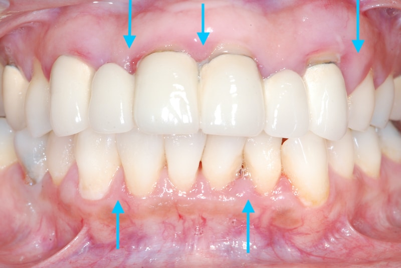 嚴重牙周病治療案例-牙周病症狀照片-治療前牙齦易紅腫出血