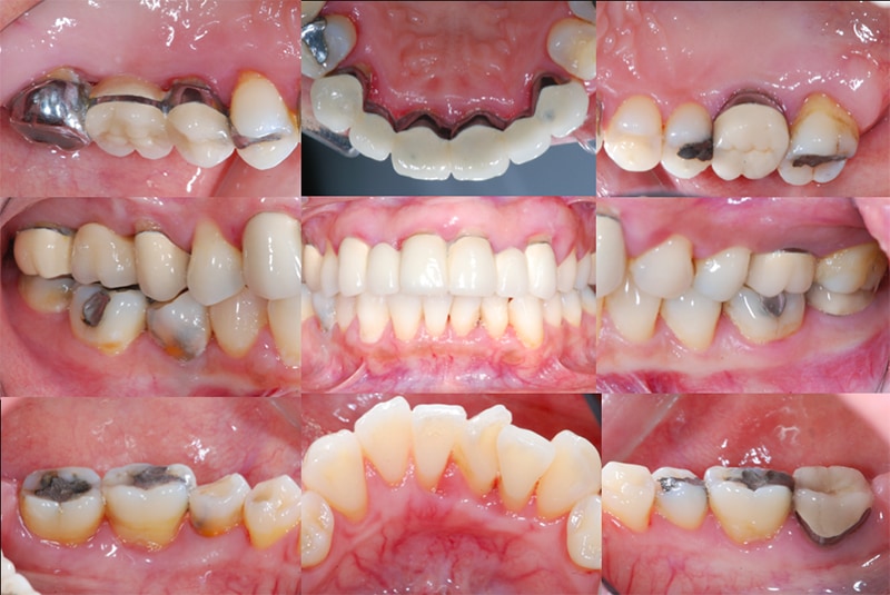 全口牙周病治療前-完整牙周檢查1-各角度口內數位照片