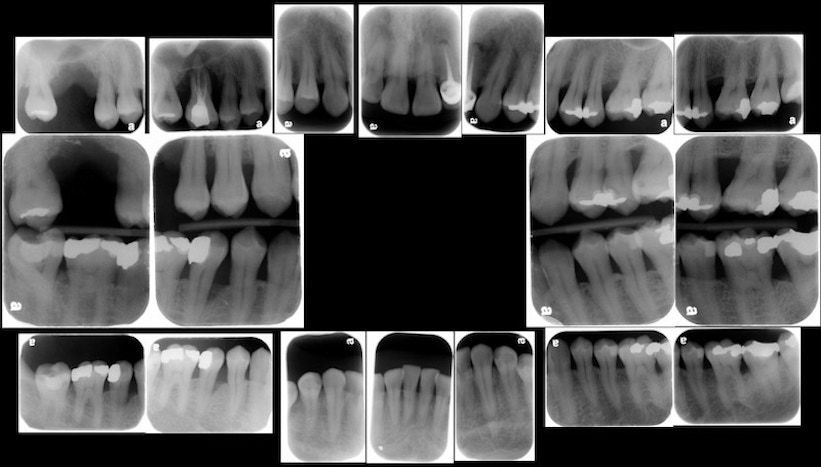 完整牙周病檢查-X光片檢查