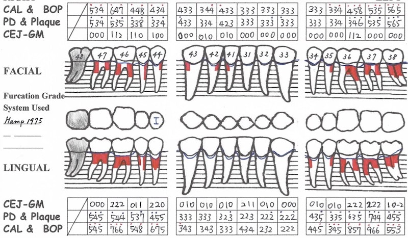 完整牙周病檢查-牙周檢查表-下顎