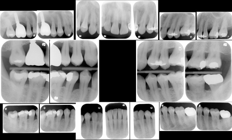 植牙假牙完成-一年後追蹤完整檢查-X光片檢查-全口牙周狀況已穩定