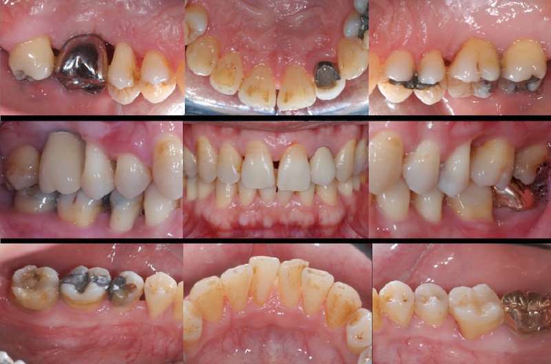 植牙假牙完成-一年後追蹤完整檢查-口內拍照紀錄-全口牙周狀況已穩定