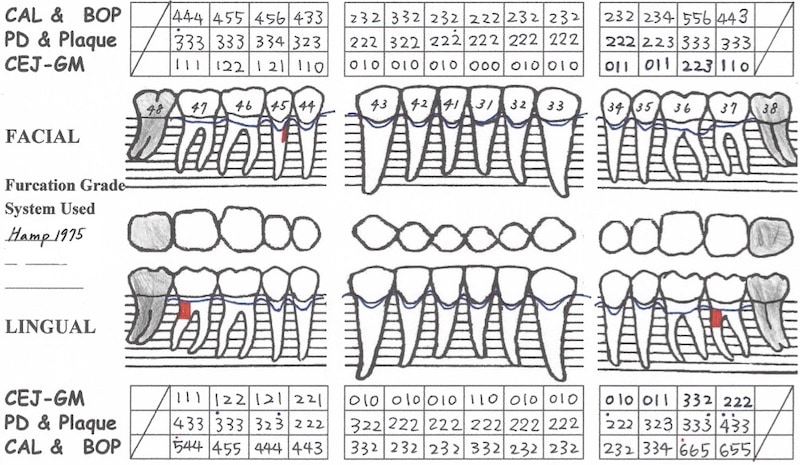 植牙假牙完成-一年後追蹤完整檢查-牙周檢查表-下顎-全口牙周狀況已穩定
