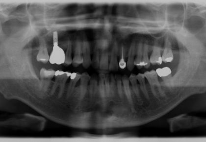 嚴重牙周病治療推薦: 全口牙周病治療/牙周翻瓣手術/鼻竇增高術補骨/植牙