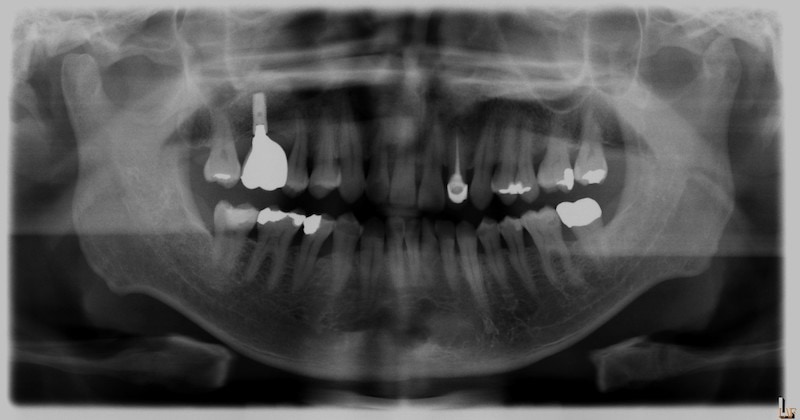 植牙手術後-環口式X光片-鼻竇增高術後-骨量明顯增高
