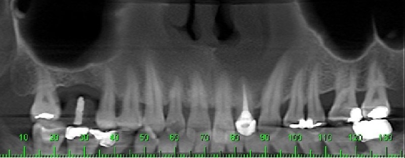 植牙評估-電腦斷層攝影-齒槽骨寬度不足