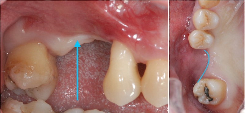 游離牙齦移植術-手術前-角化牙齦不足