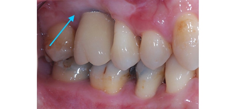 游離牙齦移植術-手術後裝上植牙假牙-角化牙齦明顯增寬