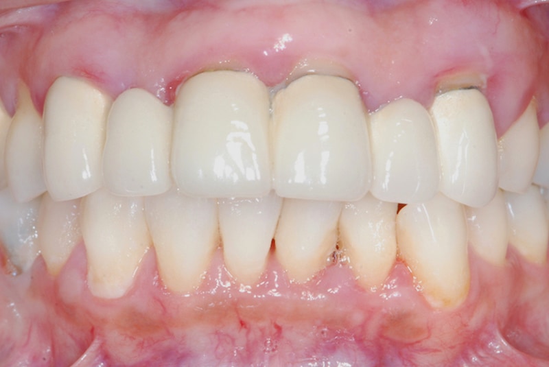 牙周治療前-前牙假牙