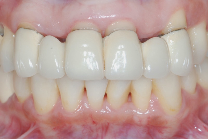 牙周治療前-舊假牙露出金屬黑邊