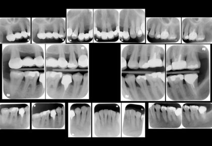 嚴重牙周病治療推薦: 全口牙周病/牙周翻瓣手術/牙周再生手術