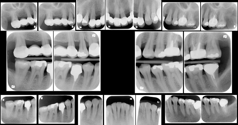牙周病手術後半年追蹤-X光片檢查