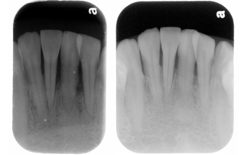 牙周病手術後半年追蹤-下顎前牙區-牙周齒槽骨無手術自然再生