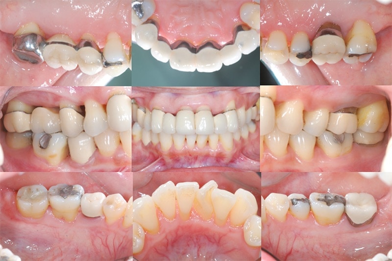 牙周病手術後半年追蹤-全口數位照片-牙周狀況良好