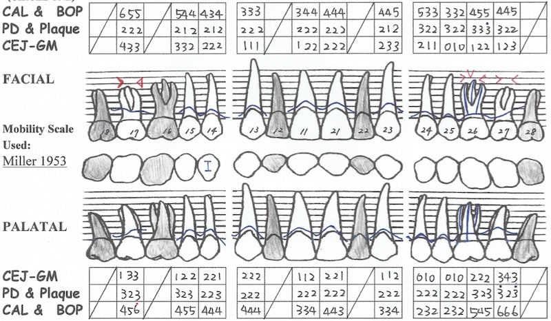 牙周病手術後半年追蹤-全口牙周檢測表-上顎