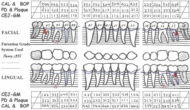 牙周病手術後半年追蹤-全口牙周檢測表-下顎