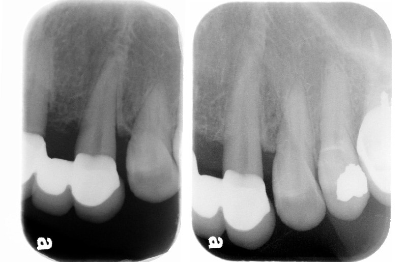 牙周病手術後半年追蹤-左上犬齒-牙周齒槽骨無手術自然再生