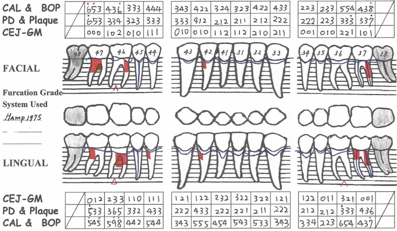 第一階段牙周病治療-再評估-下顎牙周檢查表