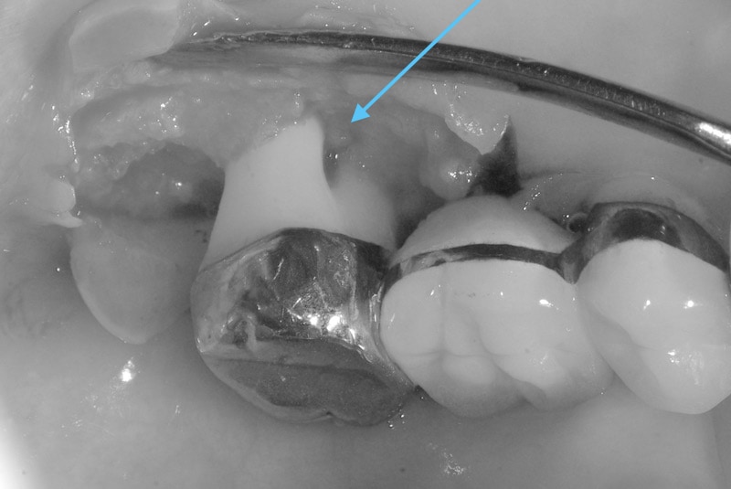 第二階段牙周病手術-右上第二大臼齒-手術中-牙周破壞至牙根分岔處