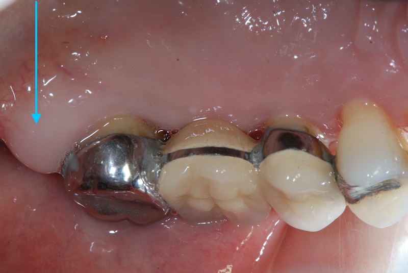 第二階段牙周病手術-右上第二大臼齒-手術前-牙齦腫大