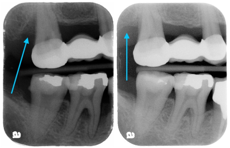 第二階段牙周病手術-右上第二大臼齒-手術前後比較-齒槽骨再生